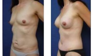 breast augmentation surgery - left lateral view