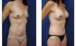 breast augmentation surgery - right lateral view