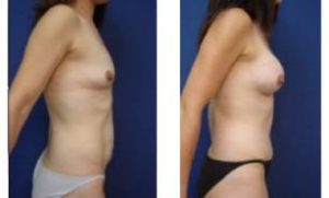 breast augmentation surgery - right view