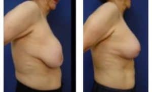 breast augmentation revision surgery - right view
