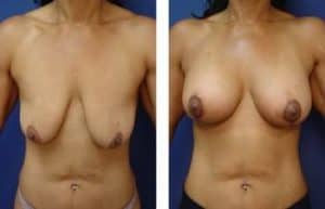 breast lift with implant augmentation surgery - front view