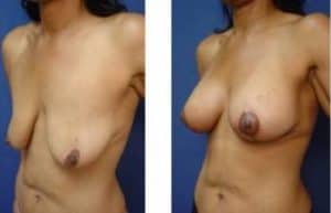 breast lift with implant augmentation surgery - left lateral view