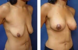 breast lift with implant augmentation surgery - right lateral view