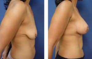 breast lift with implant augmentation surgery - right view