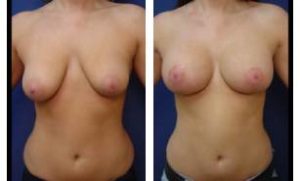 breast lift with implant augmentation - front view