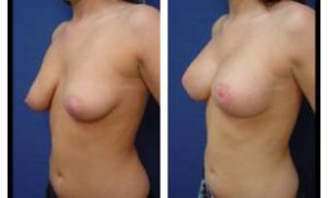 breast lift with implant augmentation - left lateral view