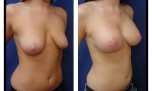 breast lift with implant augmentation - right lateral view