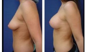 breast lift with implant augmentation - left view