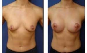 breast lift with implant augmentation procedure of a female patient - front view