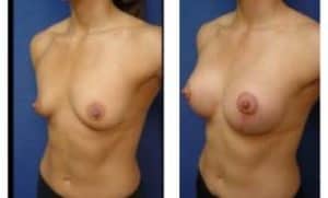 breast lift with implant augmentation procedure of a female patient - left lateral view