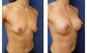 breast lift with implant augmentation procedure of a female patient - right lateral view