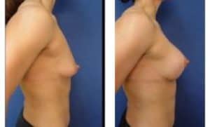 breast lift with implant augmentation procedure of a female patient - right view