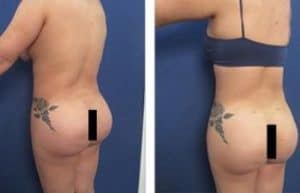 Vaser HD Liposuction with BBL surgery - back left view