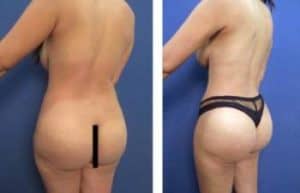 BBL with vaser hd liposuction surgery - back left view