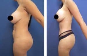 BBL with vaser hd liposuction surgery - left view