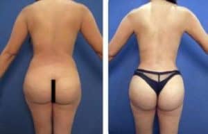 BBL with vaser hd liposuction surgery - back view