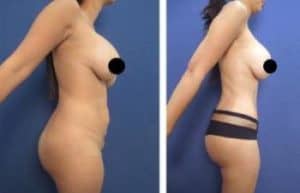 BBL with vaser hd liposuction surgery - right view