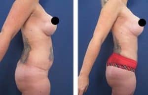 43-year-old female following VASER high definition liposuction and BBL - right view