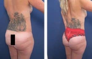 VASER high definition liposuction and BBL - back right view