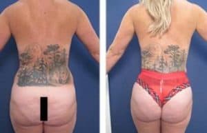 VASER high definition liposuction and BBL - back view