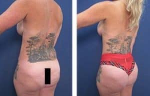 VASER high definition liposuction and BBL - back left view