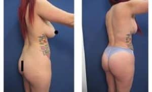 BBL and Vaser HD Liposuction - back right view