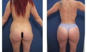 BBL and Vaser HD Liposuction - back view