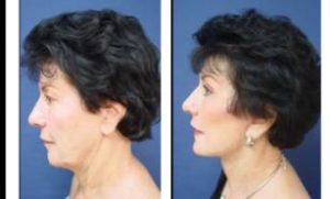 facelift surgery - left view