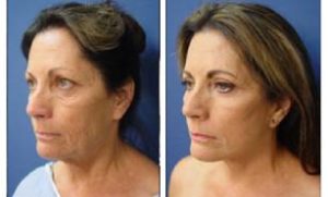 facelift scars status post face and neck lift - front left view