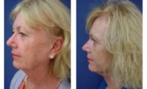 facelift pictures only 2 weeks following 2 layered face and neck lift - left view