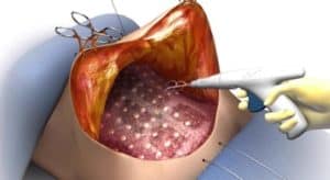 Drainless tummy tuck image