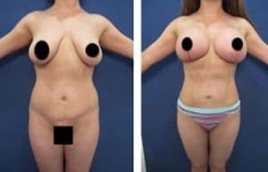 hd body contouring procedure - front view