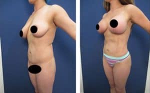 hd body contouring procedure - front left view