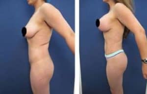 hd body contouring procedure - left view