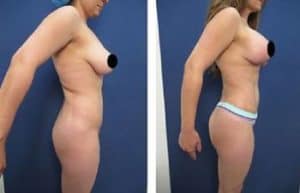 hd body contouring procedure - right view