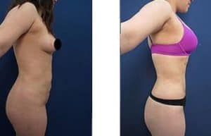 hd liposuction procedure of a female patient - right view