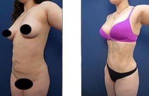 hd liposuction procedure of a female patient - front left view