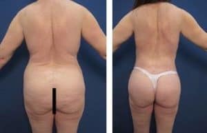 liposuction revision procedure - back view