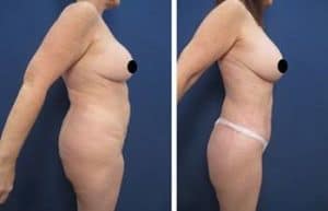 liposuction revision procedure - right view