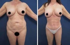 liposuction revision procedure - front view