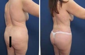 liposuction revision procedure - back right view