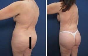 liposuction revision procedure - back left view