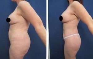 liposuction revision procedure - left view