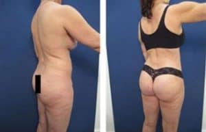 VASER hd liposuction with BBL procedure - back right view