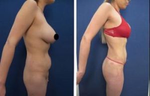 hd liposuction procedure - right view