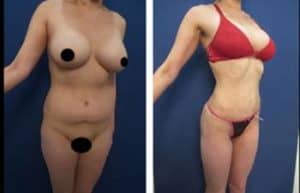 hd liposuction procedure - front right view