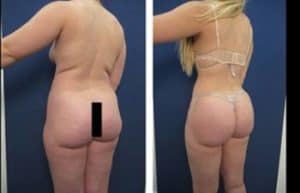 hd liposuction procedure - back left view