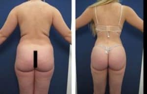 hd liposuction procedure - back view