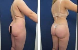 hd liposuction procedure - back right view