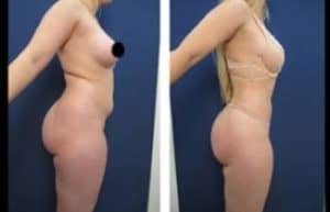 hd liposuction procedure - right view